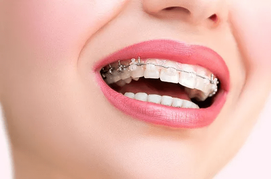 戴钢牙套的注意事项一次告诉你