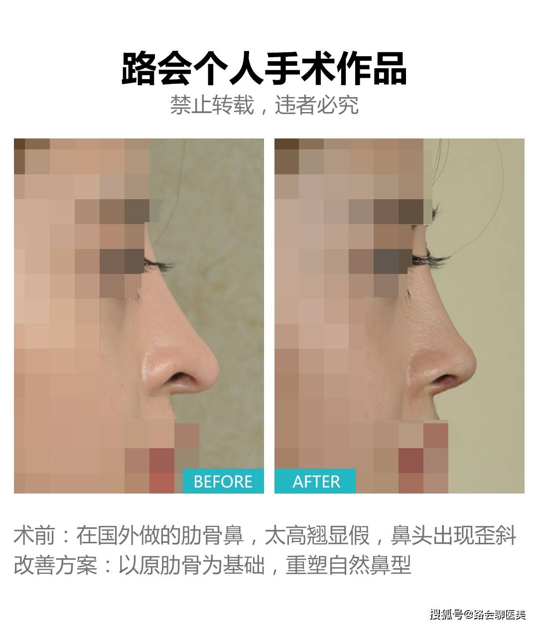 整形医生，你太搞笑了吧？做“妈生鼻子”不就是在做“寂寞”吗？