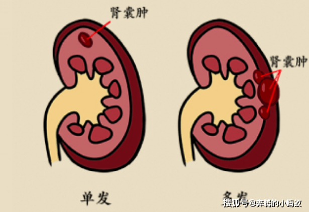 治疗|肾囊肿影响大，生活中预防是关键！另附不手术消除的方法！