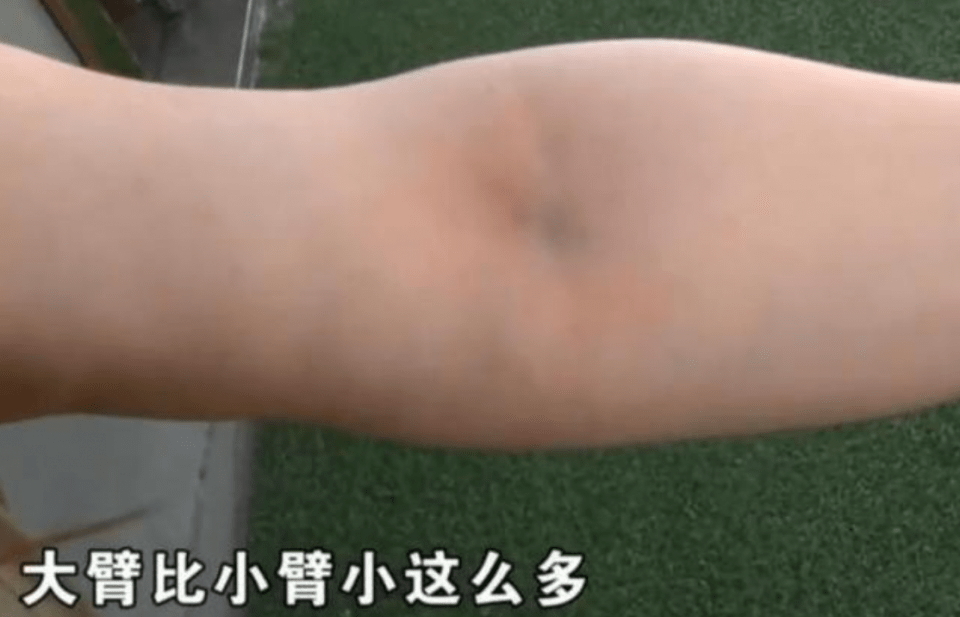 因为女子花6万整容，脸上天天挂着注射器，医院：赔你13000