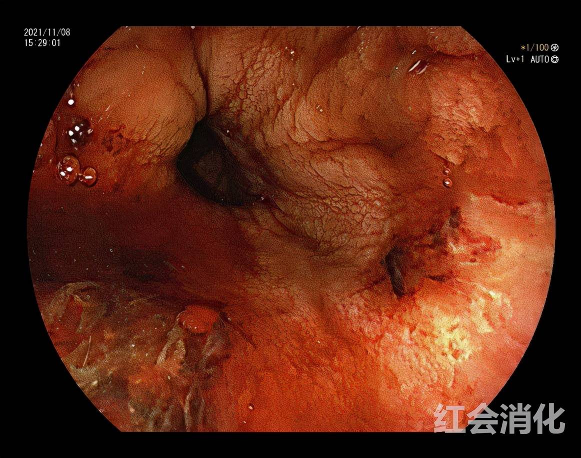休克|小伙遇车祸消化道大出血休克 西安市红会医院紧急救治挽生命