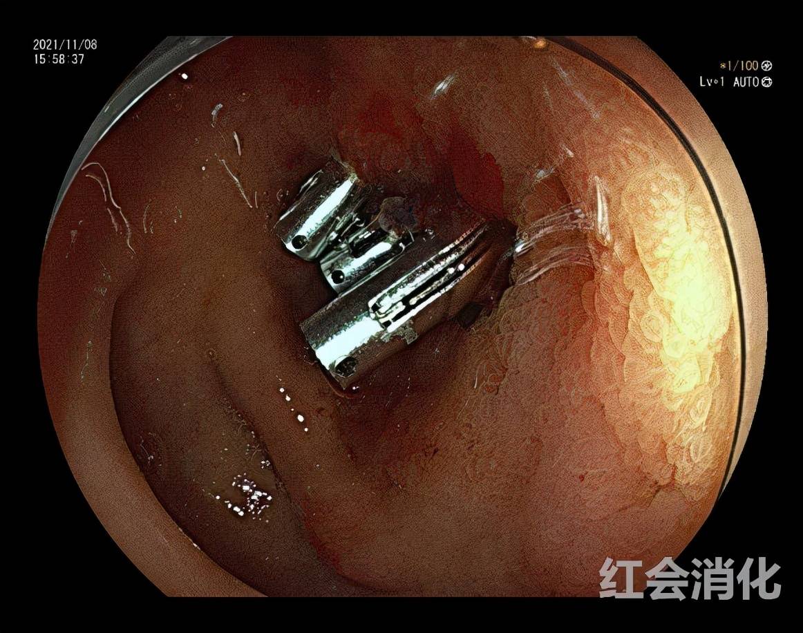 休克|小伙遇车祸消化道大出血休克 西安市红会医院紧急救治挽生命