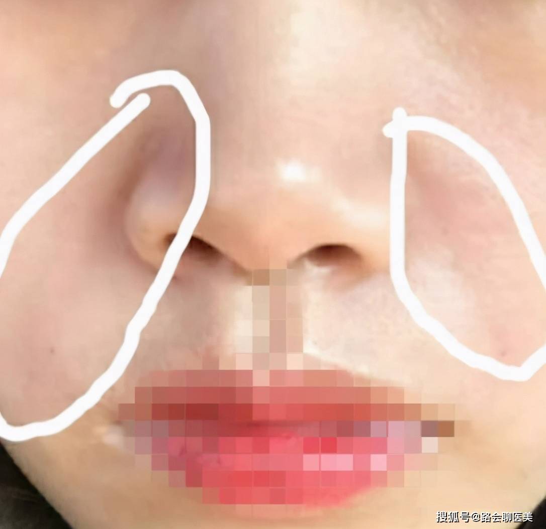 血管想做玻尿酸填充，看完这篇不走弯路