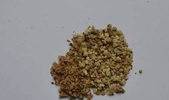 肾脏|肾结石来临时，身体会出现这些信号，别对此不屑一顾！