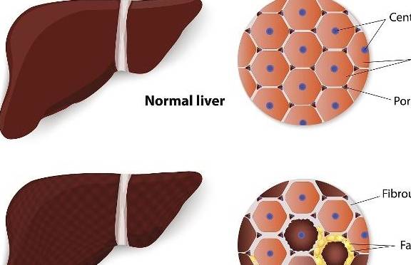 物质|肝脏是怎么一步步生病的？这5种原因，你要揪出来