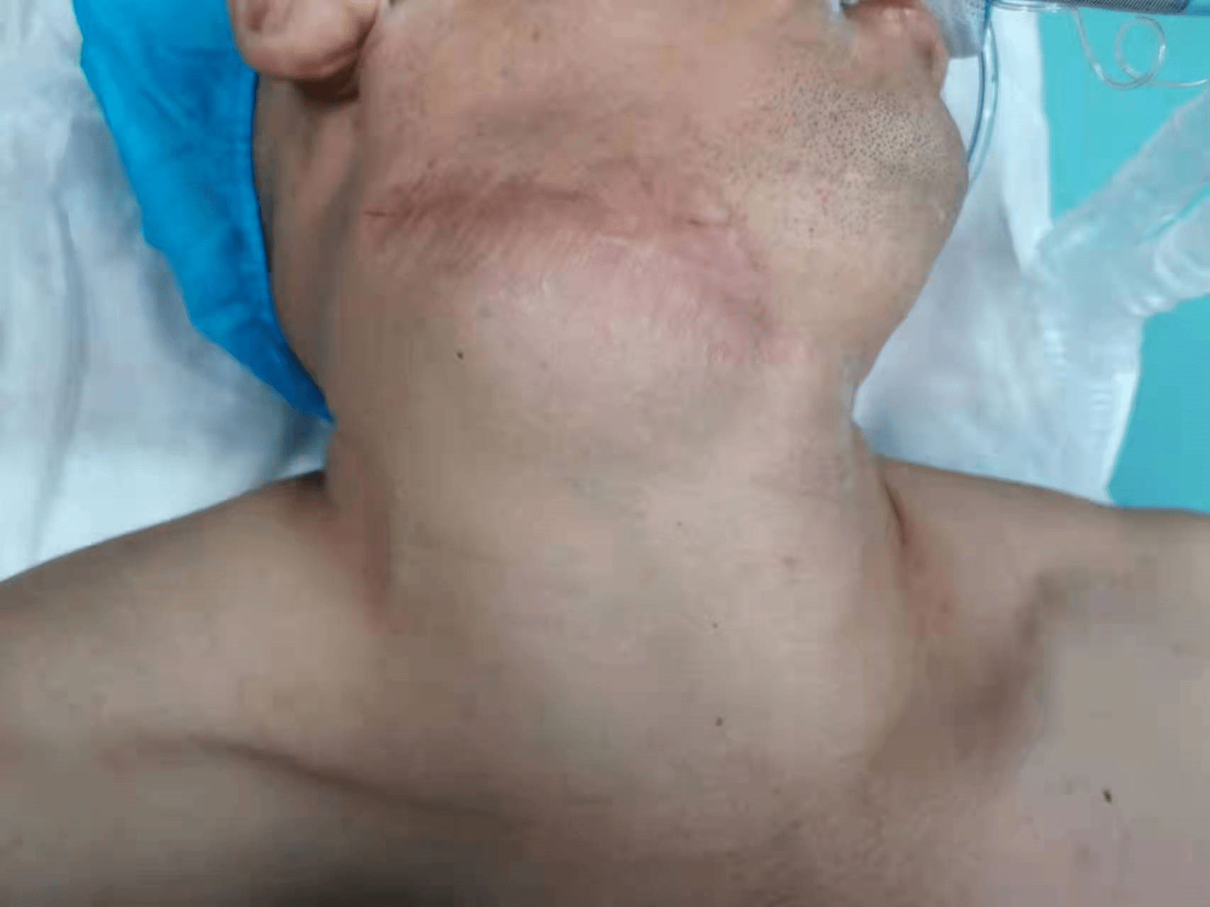 肿瘤|颈部包块竟是巨大颈动脉体瘤，湘雅专家“拆弹”助男子脱险境