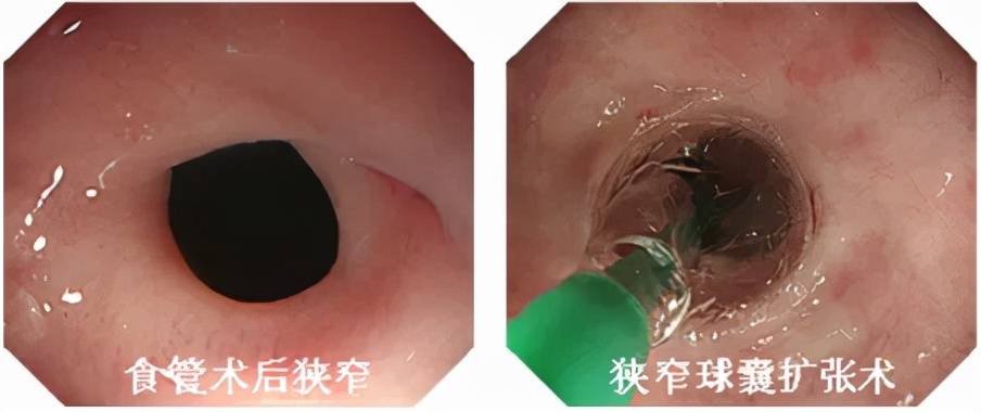 难以言说的痛苦——记消化道术后吻合口狭窄治疗_阿姨