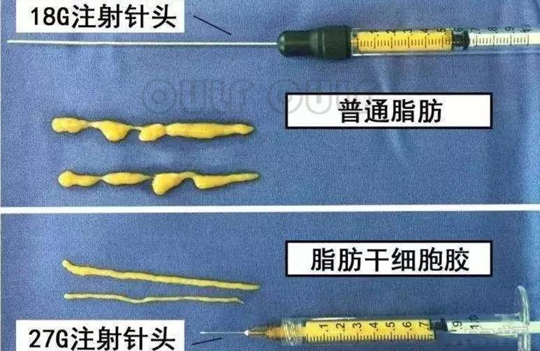 SVF-gel脂肪胶全脸填充要多少钱，要3万块钱是不是有点贵~