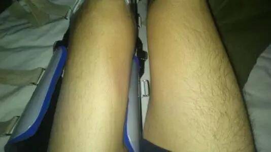 胳膊|运动神经元损伤会全身麻木