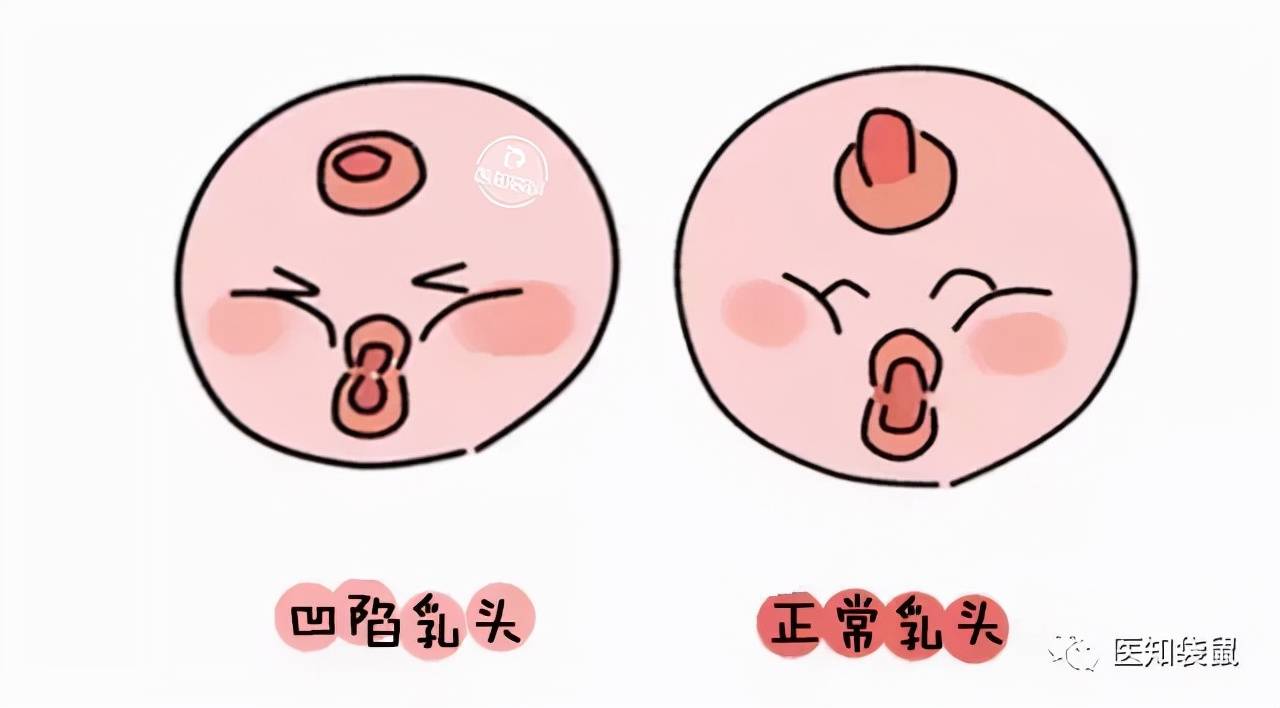 乳房图凹陷图片