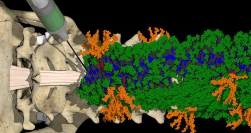 成功|一针逆转瘫痪？美西北大学研发“跳舞”分子，成功修复脊髓损伤