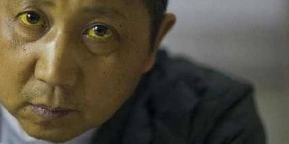 进行|肝不好时，可能有“3黄2臭”的表现，远离“4怕”，肝会一天天好