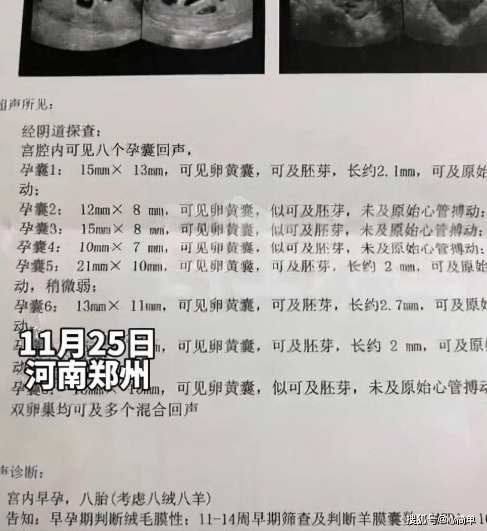 11月25日郑州一女子怀上八胞胎 医生建议打掉家人考虑减胎