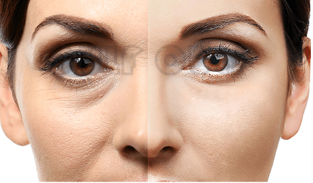 脸部全面还原:脸部脂肪填充恢复过程，全脸脂肪填充5到10天照片~