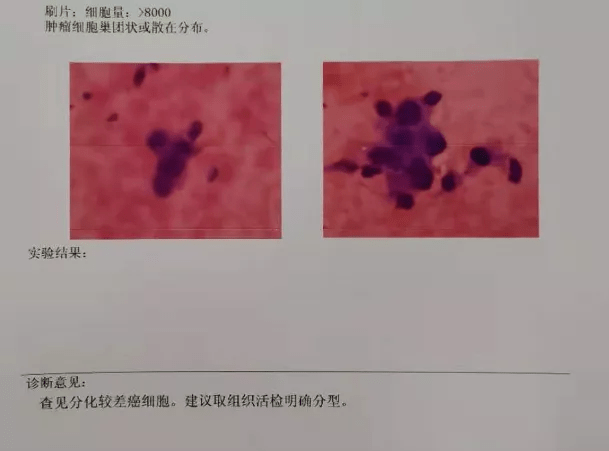 病理报告后记:遇到双肺多发的神奇小结节,单独看ct有时候不容易诊断