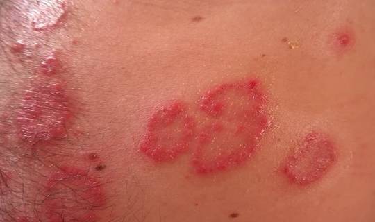 几类|冬季易复发肾病！这几类人群要小心！