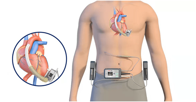 国内首款全磁悬浮式人工心脏获批上市