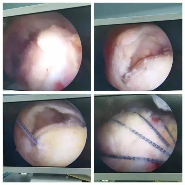 肩關節鏡解決肩病傷痛煩惱_手術_診斷_活動