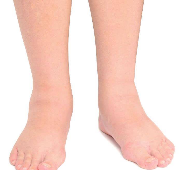 肾脏|专家提醒:尿毒症早期有4个异常,特别是小便时出现这个信号