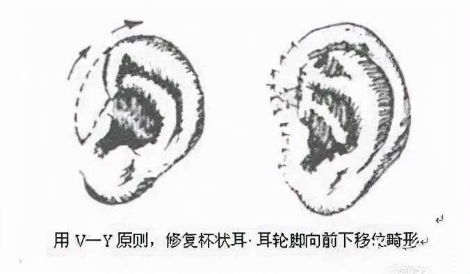 要怎麼修復?_耳廓_耳輪_畸形