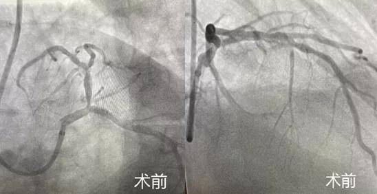 冠脉|冠脉内旋磨｜拿起“金刚钻”降服钙化保健康