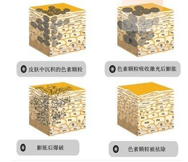 艾美莉盐城艾美莉整形医美科普长雀斑、老年斑、晒斑怎么办