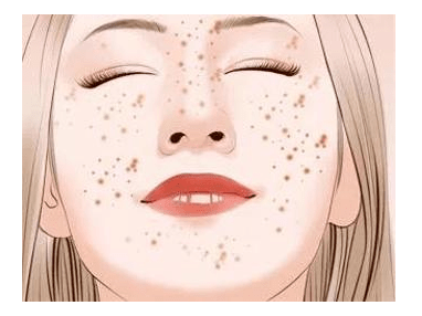 艾美莉盐城艾美莉整形医美科普长雀斑、老年斑、晒斑怎么办