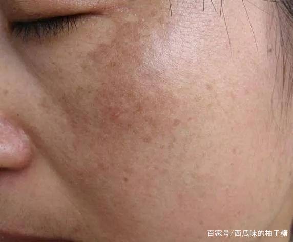 排名第一淡斑祛斑用什么护肤品效果最好？淡斑效果排名第一的这三款很不错！