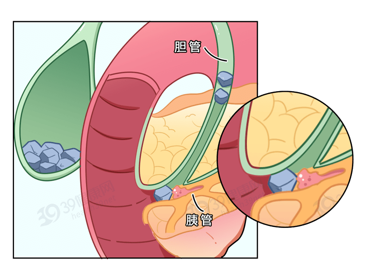 癌症之王胰腺癌不要以為是胃病出現3個症狀及時就醫