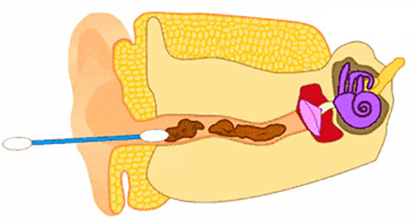 脂肪酸|掏耳朵导致耳朵发炎 来成都民生耳鼻喉医院就对了