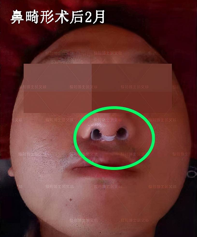 唇裂鼻畸形鼻模鼻撑怎么选需要佩戴多长时间