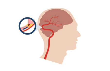 手腕|经常手麻，要小心是不是身体出了问题！这些疾病都可能引起手麻