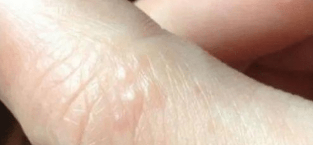 物质|手上若有这3个现象，可能是尿酸高了，若做好3件事，或能改善尿酸