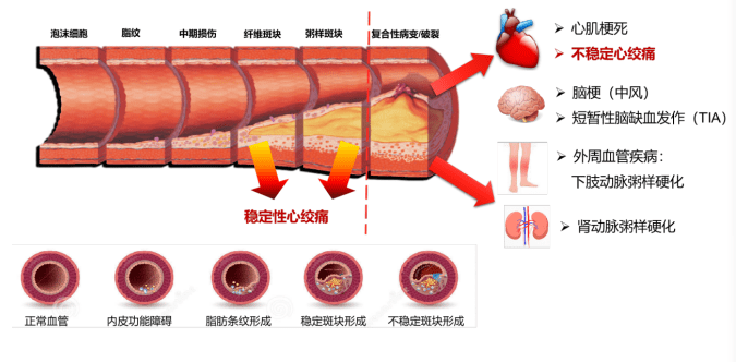 心血管疾病重要发病基础动脉粥样硬化