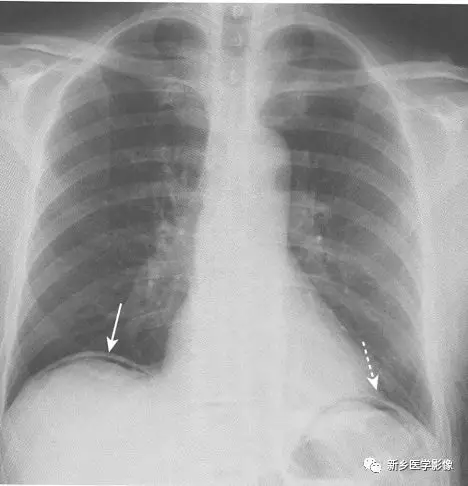 3個徵象辨識腹腔遊離氣體