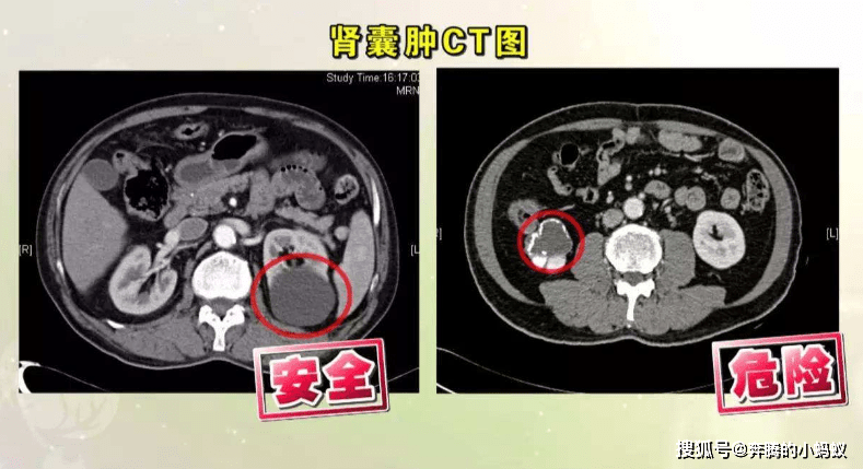 淤血|哪些肾囊肿需要手术治疗？