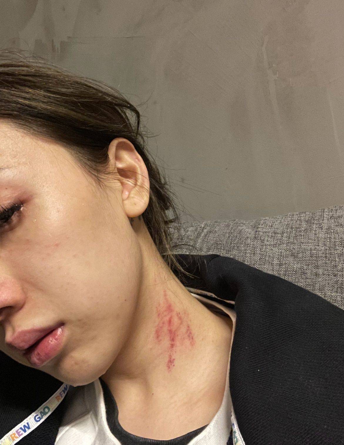 女歌手控诉前任,多次遭他家暴致耳膜穿孔,受伤照里脖子都是抓痕