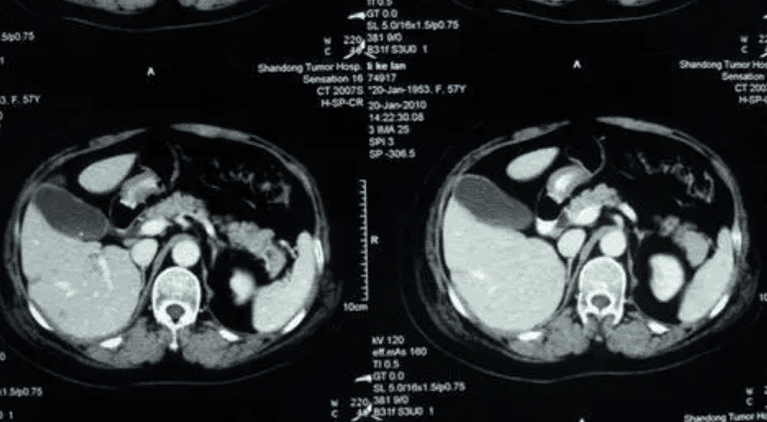 肝脏|肝脏“清道夫”被发现，医生：平时吃吃远离肝癌，肝功强健如少年