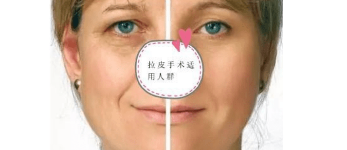 什么惊爆：拉皮风险大吗、拉皮手术的风险和后遗症是什么！别上当！