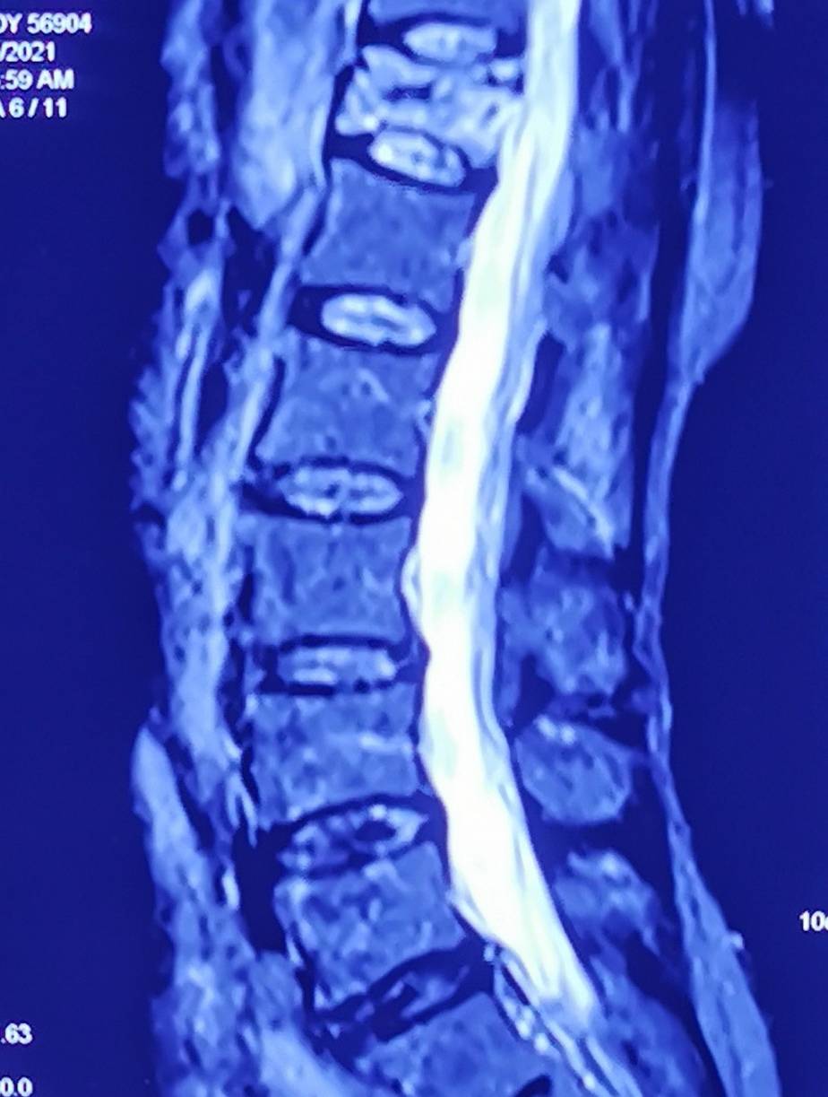 癌症|【读报】腰背长期疼警惕恶性肿瘤