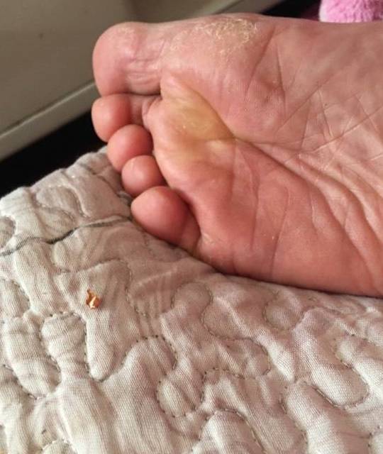 肝脏|肝好不好，看脚就知道，若没有这些变化，说明肝很干净