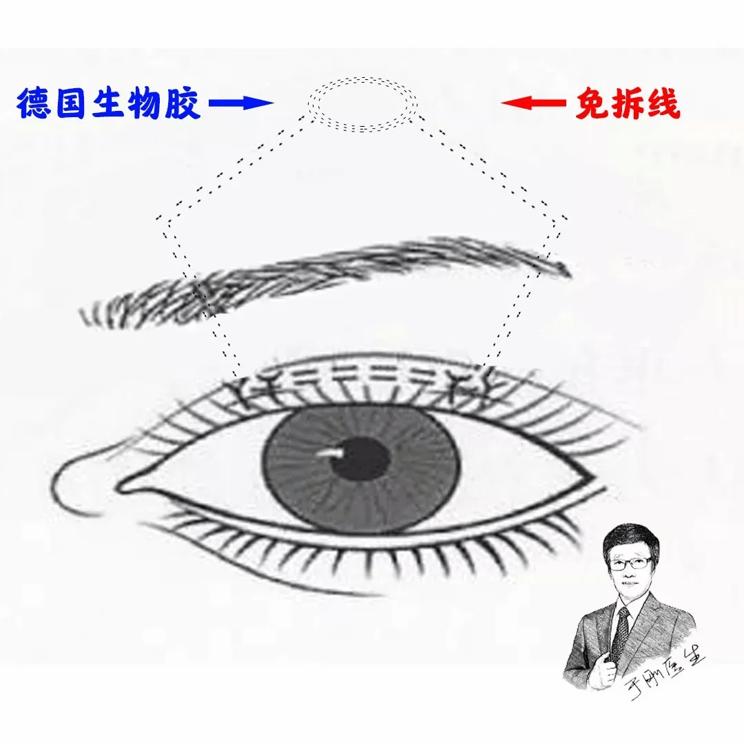 手术|五年八部曲，上睑下垂分阶段治疗的故事