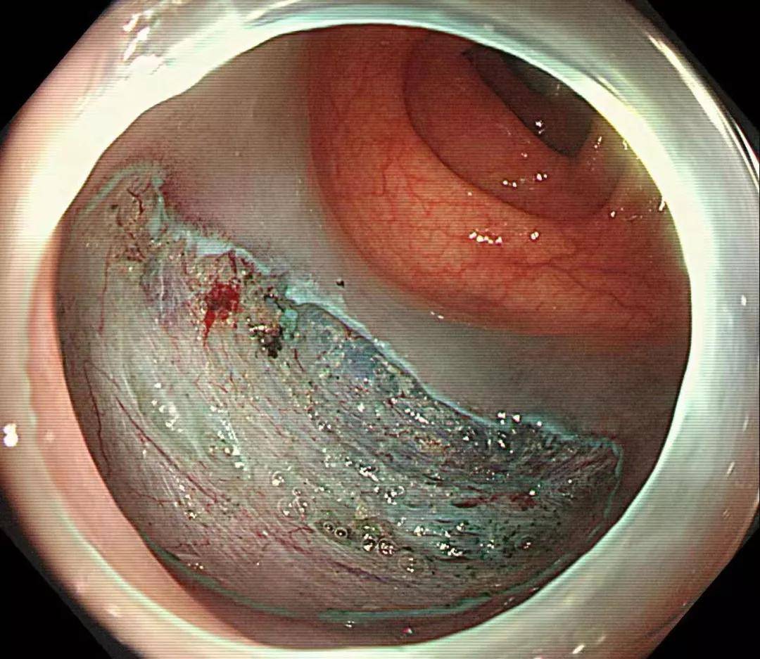 技术|结肠多发侧向发育型肿瘤（LST）内镜下精准诊治——双镜联合技术的再应用