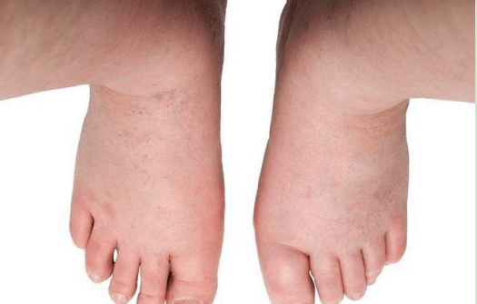 红灯|身体3处异常，或是尿酸飙升的“红灯”，切莫大意！