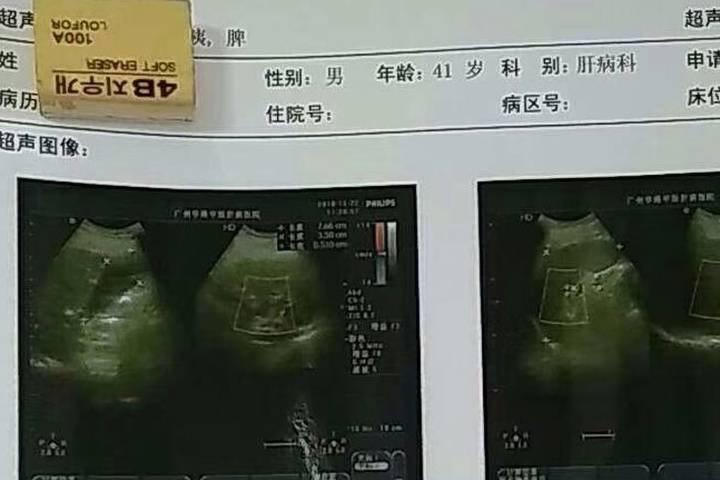 肝脏|小三阳十几年，发展为肝硬化，还能治好吗？这3位医生说了大实话