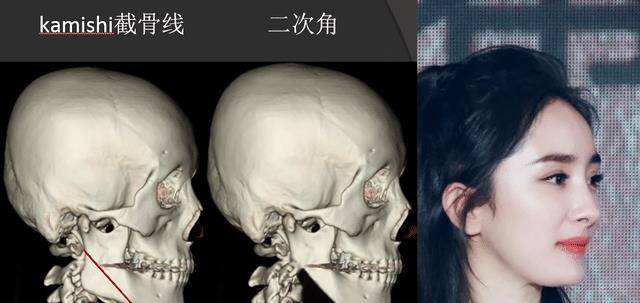 变化那些削骨“一刀切”的明星还好吗？有的已垮掉，小方脸成最后赢家