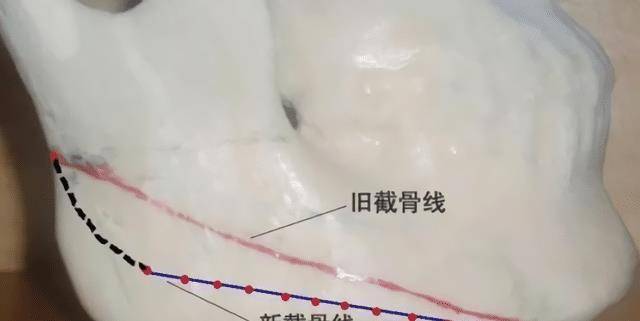 变化那些削骨“一刀切”的明星还好吗？有的已垮掉，小方脸成最后赢家