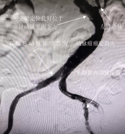 手术|咸阳市第一人民医院：微创精准拆除患者腹中“不定时炸弹”