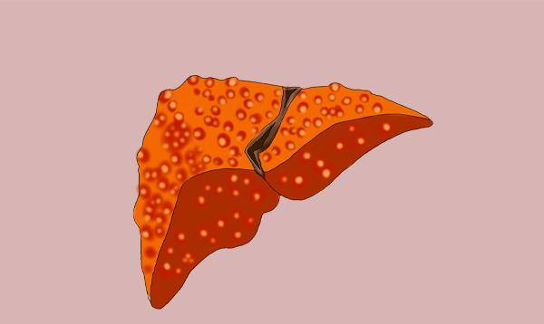 进行|肝功能不好的人，腹部会有什么表现？异常全占，要当心肝硬化