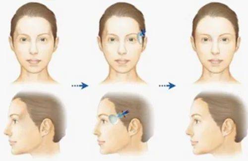 禁忌面部轮廓不流畅，填充还要分情况，太阳穴填充有什么禁忌？